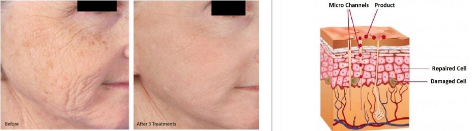 MicroNeedling Before and After